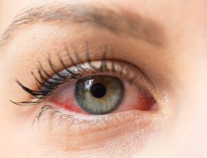 Yaz Aylarında Göz Nezlesine Dikkat: Her Kızarıklık Alerji Değil!