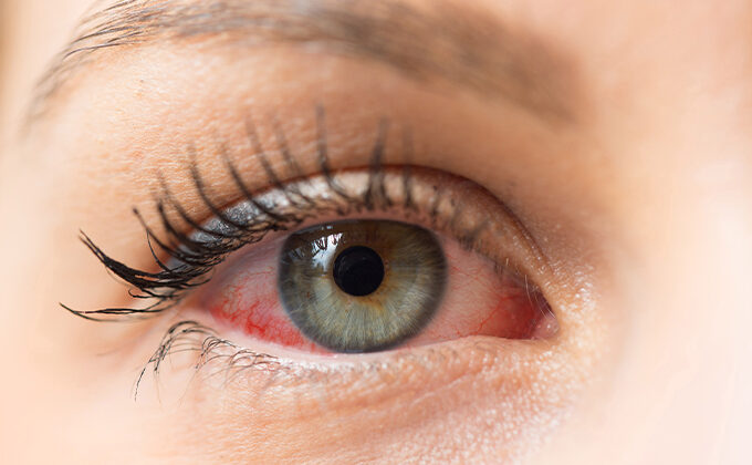 Yaz Aylarında Göz Nezlesine Dikkat: Her Kızarıklık Alerji Değil!