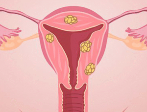 Kadınların Sessiz Düşmanı Miyomlar! Prof. Dr. Görgen’den Hayati Uyarılar