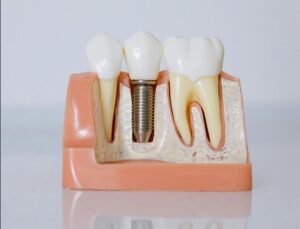 Ön Dişlerdeki Kırık ve Doku Kayıplarına Çözüm: “Lamina Uygulamaları Yüz Güldürüyor!”