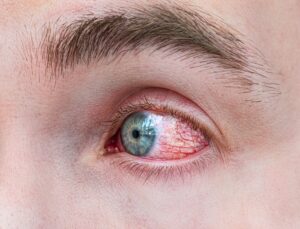Göz Alerjisi Görme Kaybına Sebep Olabilir