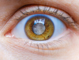 Katarakt Herkesin Kapısını Çalabilir: Başhekim Asena’dan ‘Femtosaniye Lazer’ Vurgusu!