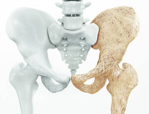 20 Ekim Dünya Osteoporoz Günü: Kemik Erimesi Sinsi Bir Hastalık, Uzmanlar Erken Tanı İçin Uyarıyor!